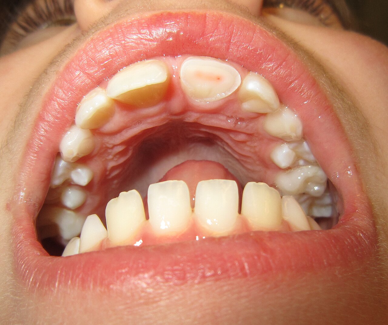 Clinical photo of a fractured tooth requiring emergency dental treatment